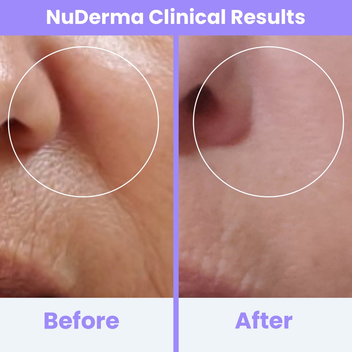 Heyglam x NuDerma Clinical High Frequency Wand