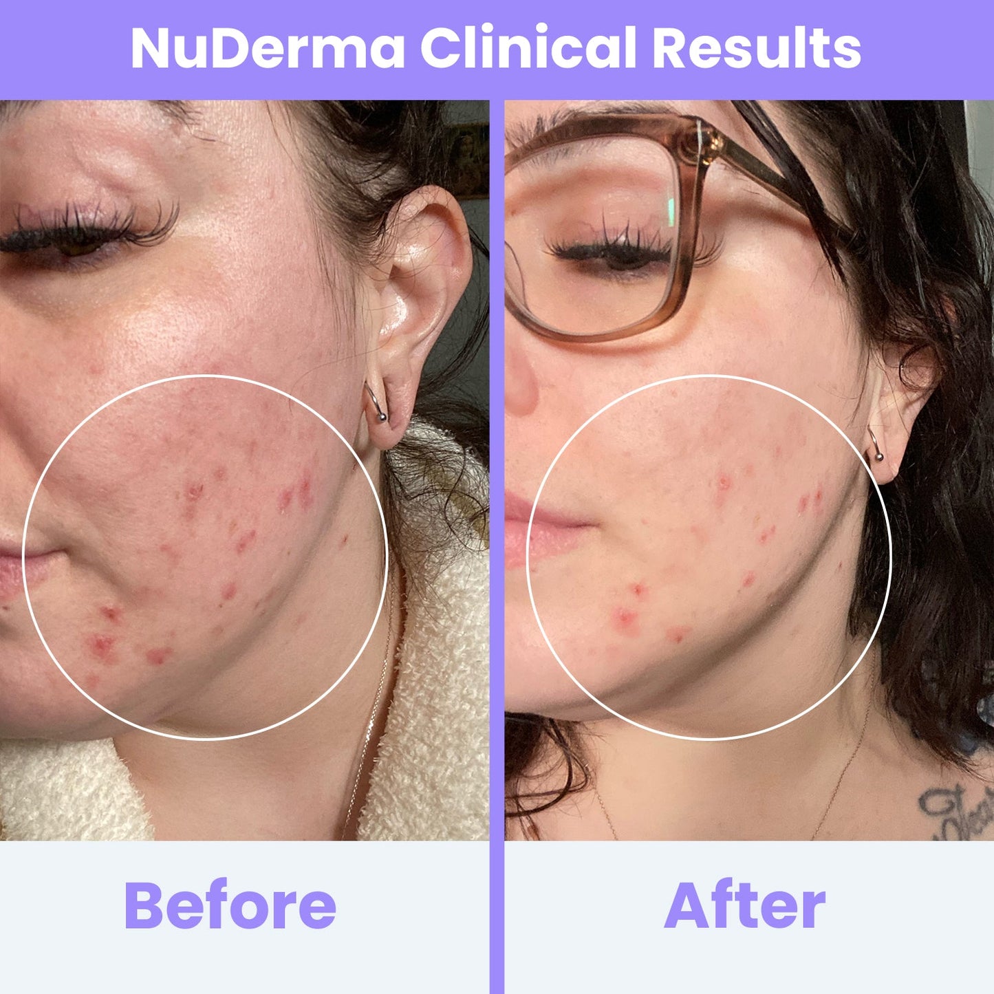 Heyglam x NuDerma Clinical High Frequency Wand