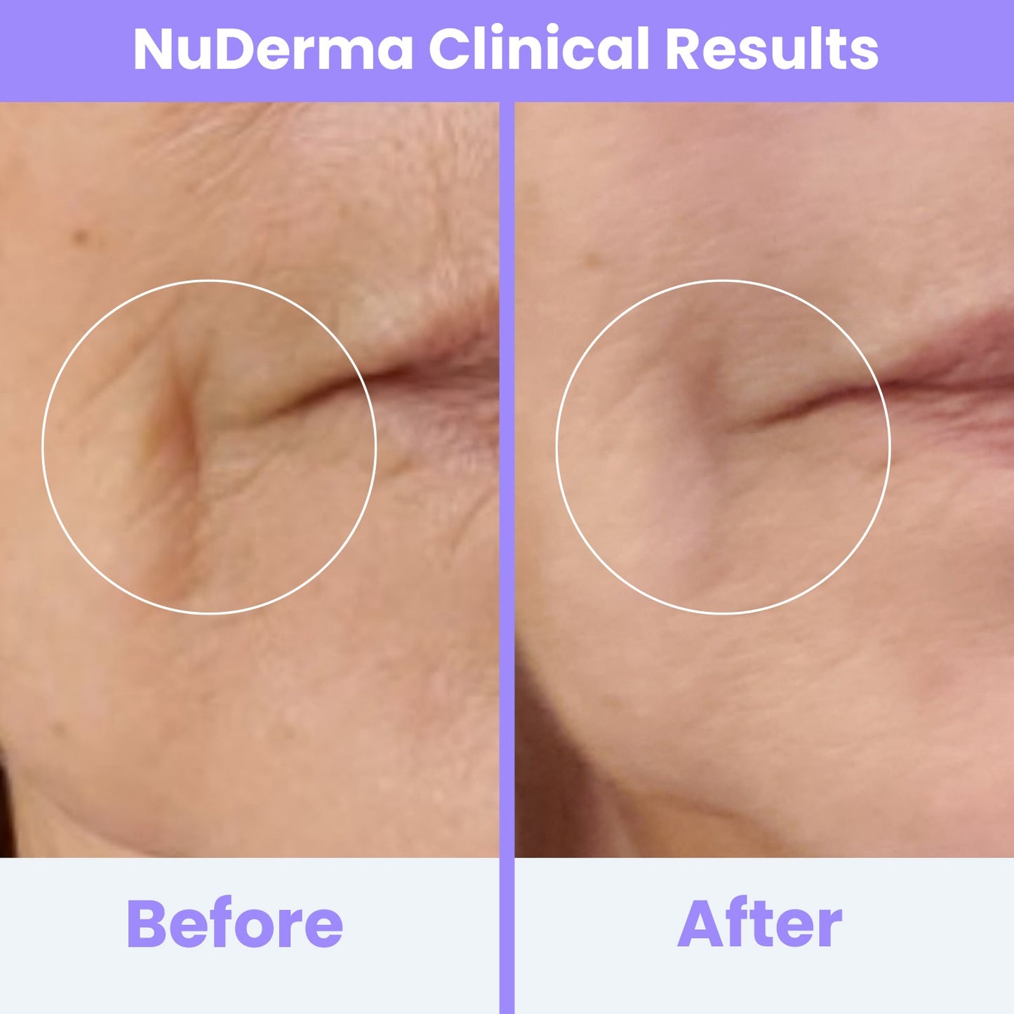 Heyglam x NuDerma Clinical High Frequency Wand