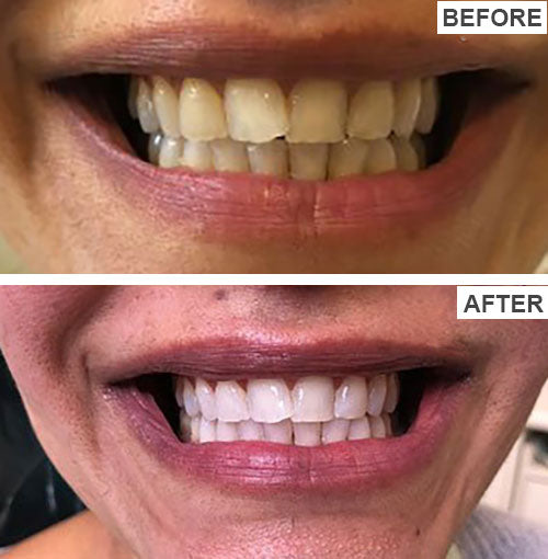 Total Teeth Whitening Smile Makeover Bundle Offer Kit