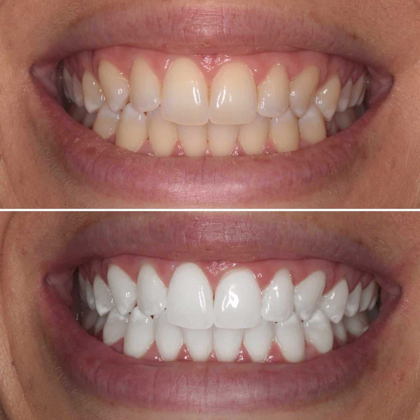 Total Teeth Whitening Smile Makeover Bundle Offer Kit