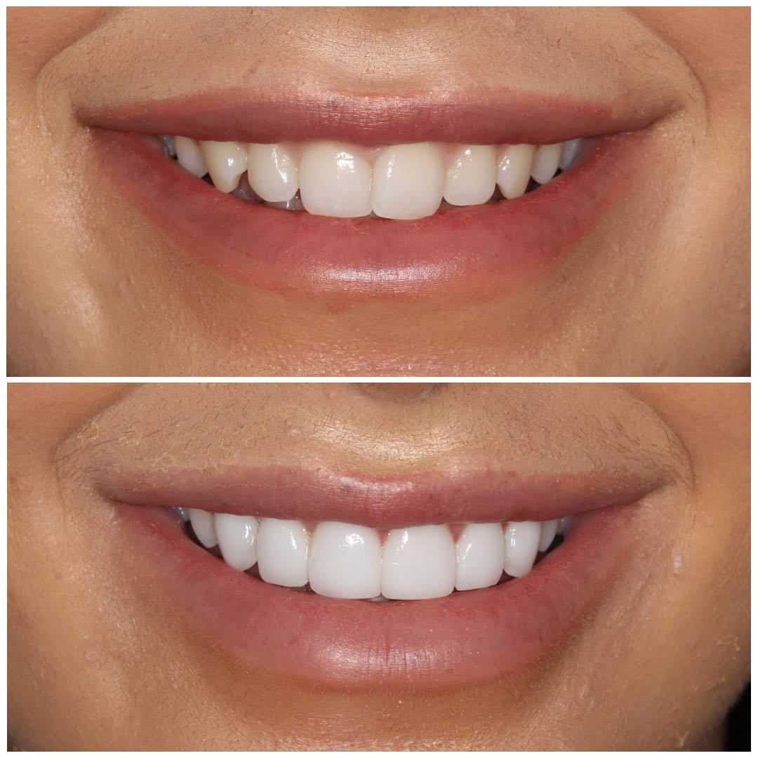 Total Teeth Whitening Smile Makeover Bundle Offer Kit