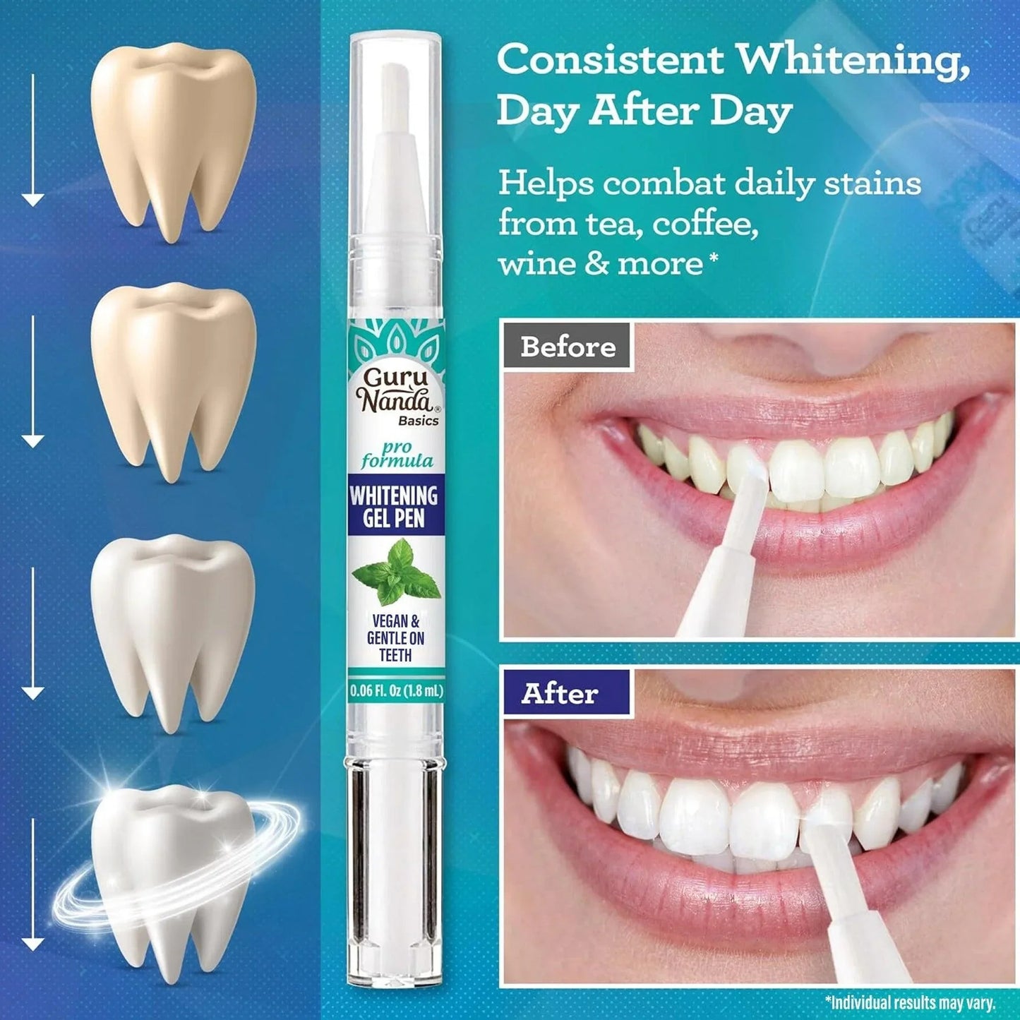 Total Teeth Whitening Smile Makeover Bundle Offer Kit