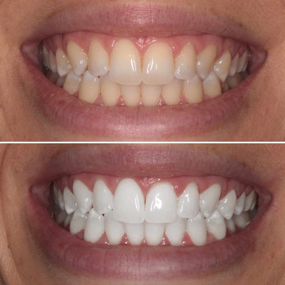 Total Teeth Whitening Smile Makeover Bundle Offer Kit