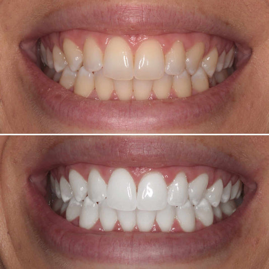 Total Teeth Whitening Smile Makeover Bundle Offer Kit